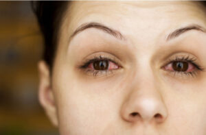 Read more about the article Eye Flu Symptoms: Causes Symptoms and Treatment