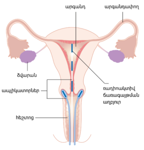 Read more about the article Cervical Cancer: Understanding