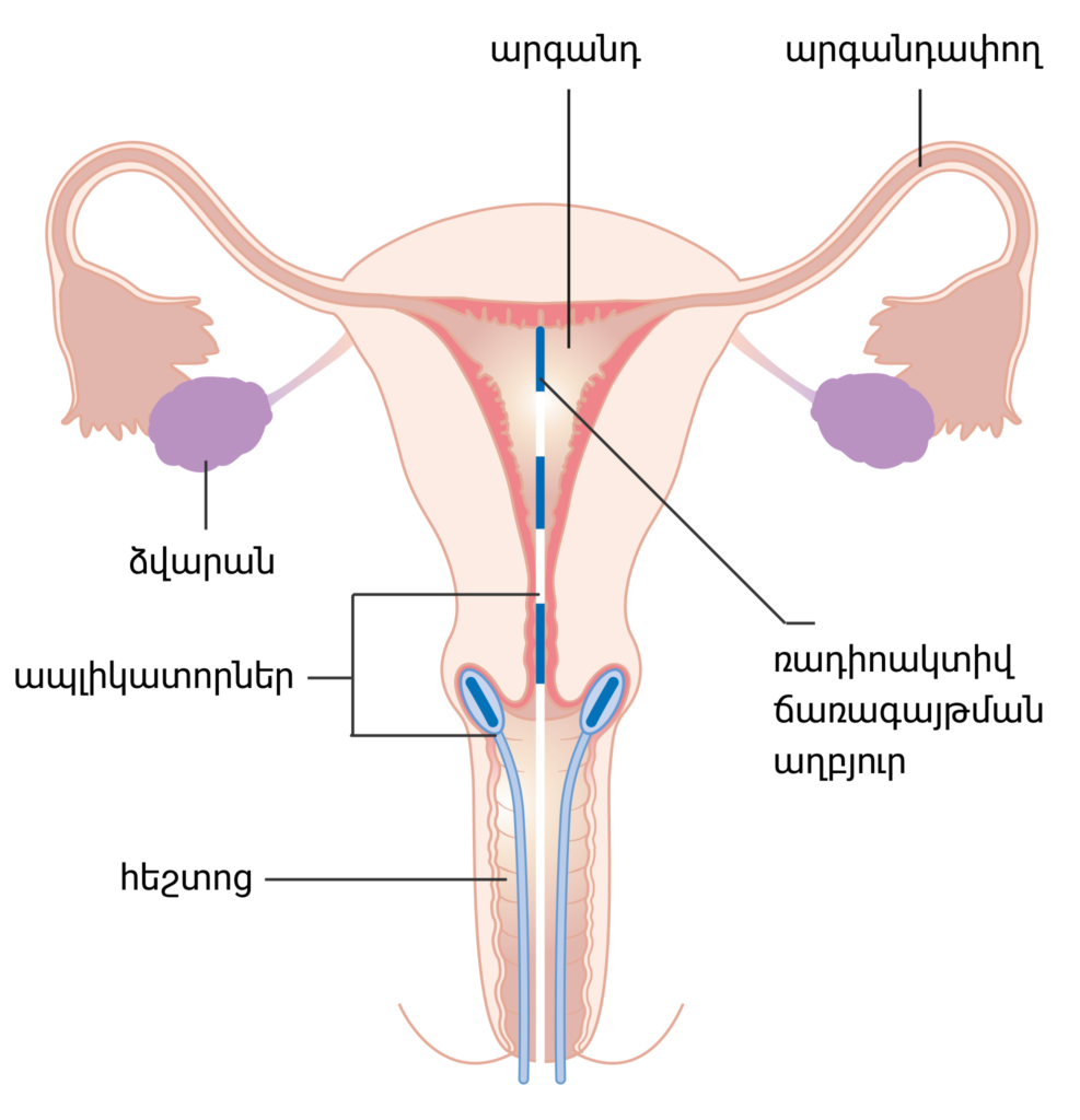 Cervical Cancer: Understanding